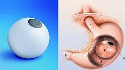 Внутрижелудочная баллонная система